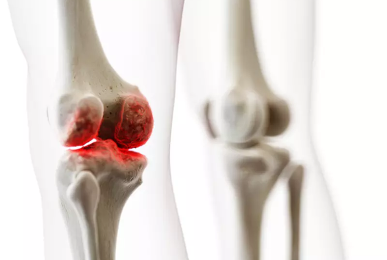 دکتر التهاب مفاصل - ( مشهد