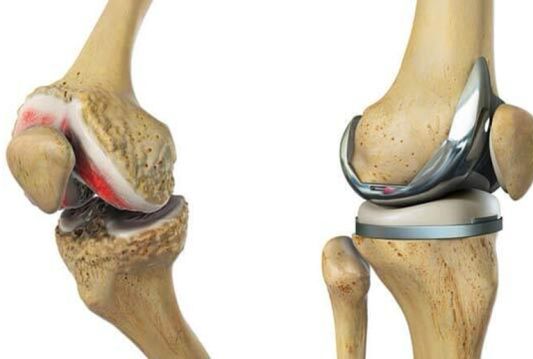 دکتر ترمیم غضروف - کرمان