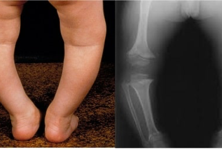 دکتر نرمی استخوان (استئومالاسی) - ( بندرعباس )